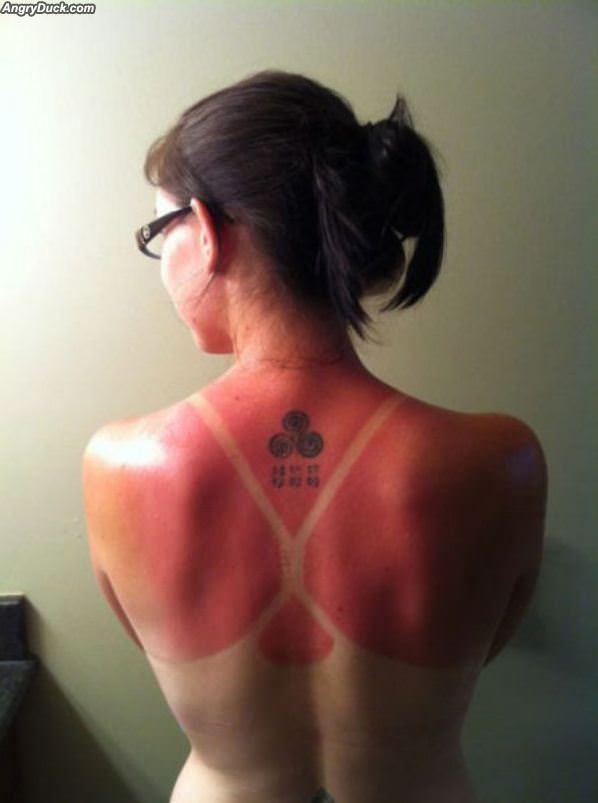 Terrible Sunburn