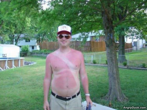Fun Sunburn