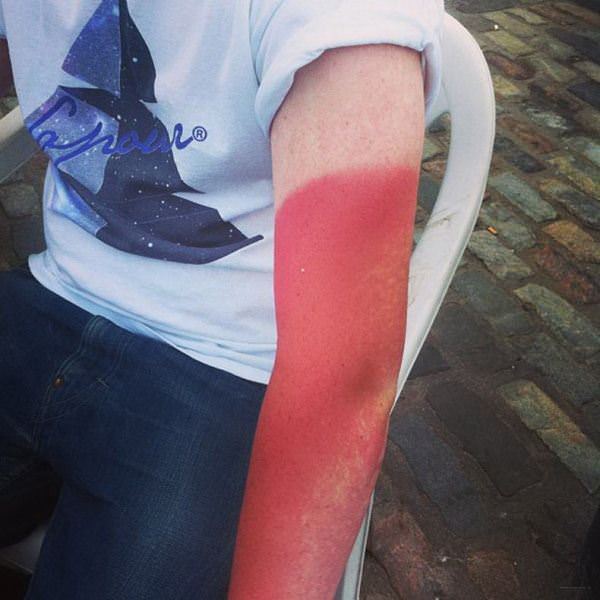 Nice Sun Burn